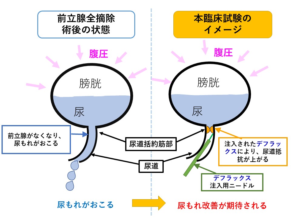 前立腺がんの凍結療法はどのように機能しますか?